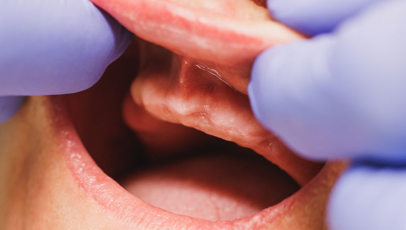 alt_La ce riscuri te expui în caz de edentatie (pierderea dintilor)?