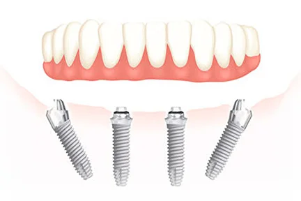Dantură fixă All on 4 Premium